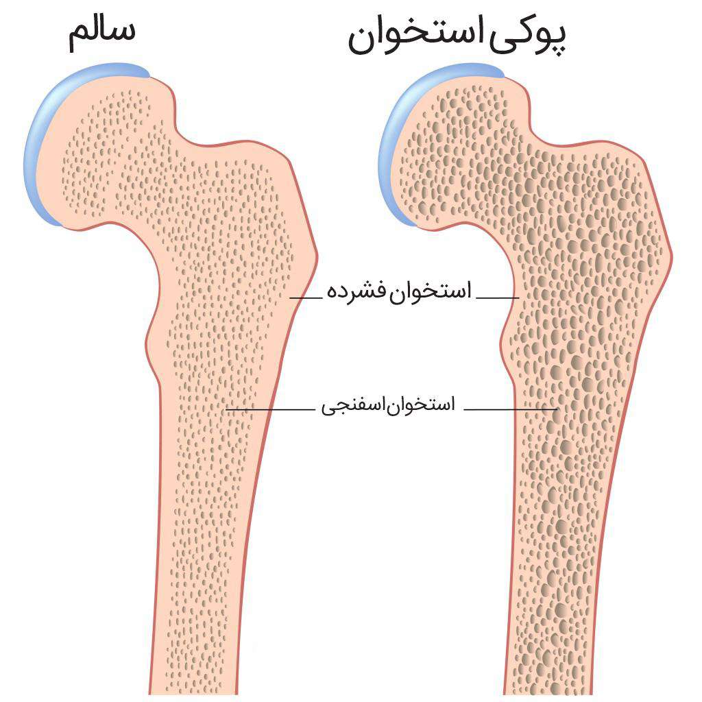 بهبود سلامت استخوان با جینسینگ هندی